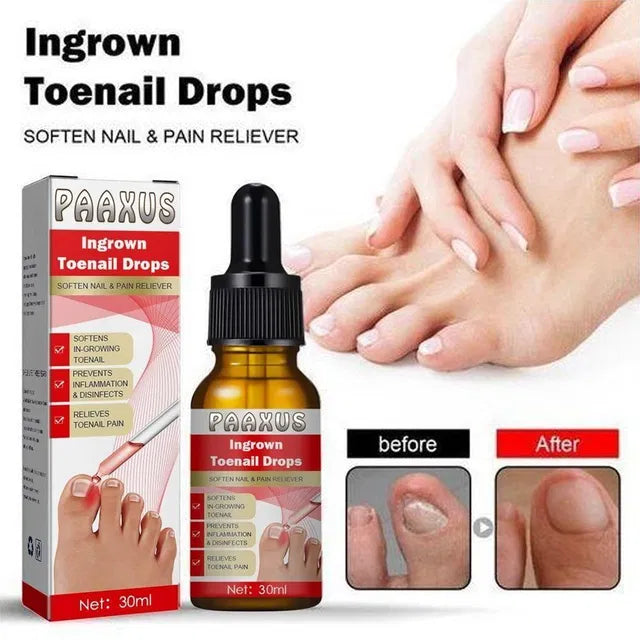 Ingrown Toenail Drops 60 ml Pack of 2
